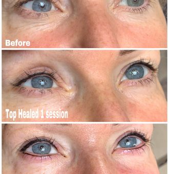 Eyeliner-Cosmetic-Tattoo Eyeliner Tattoos