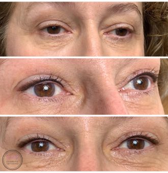 Permanent Eyeliner Melbourne