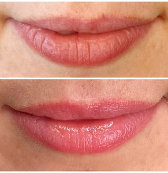 Cosmetic Lip Tattoos
