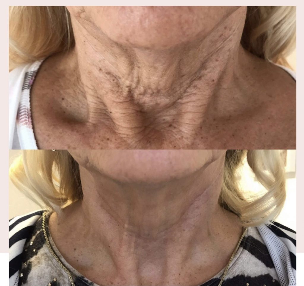 Plasma Fibroblast Treatment