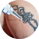 Picoway laser tattoo removal