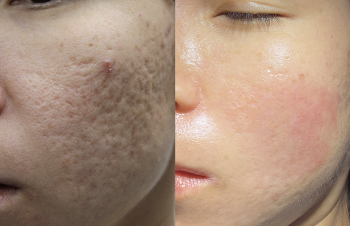 Acne Scar Pore Reduction Laser Treatment Melbourne