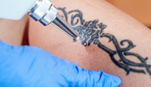 PicoWay Laser Tattoo Removal