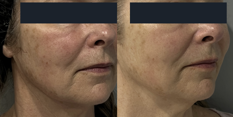 HIFU Treatment - Before And After