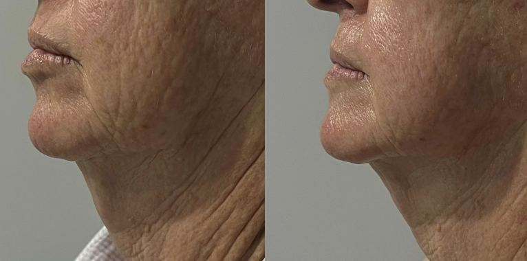 High Intensity Focused Ultrasound for Face Lifting