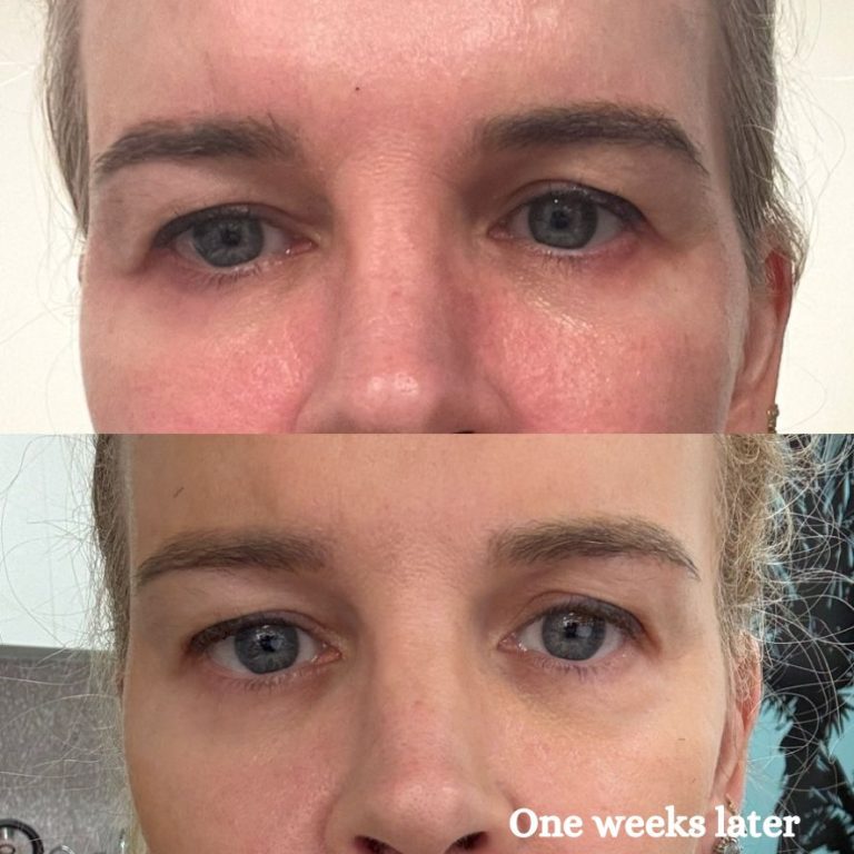 Eye lift HIFU Melbourne