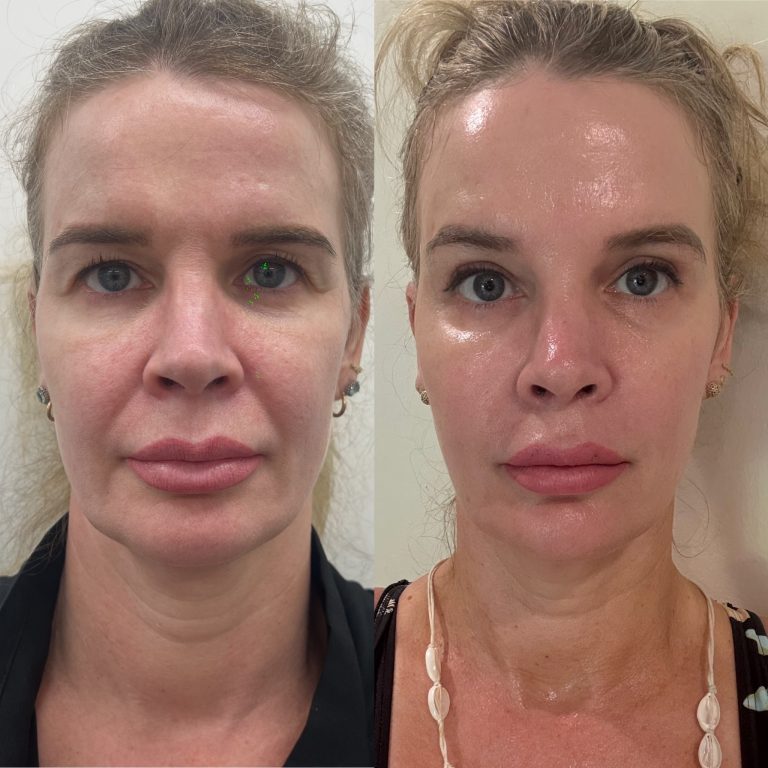 Ultrafomer MPT skiin tighenting