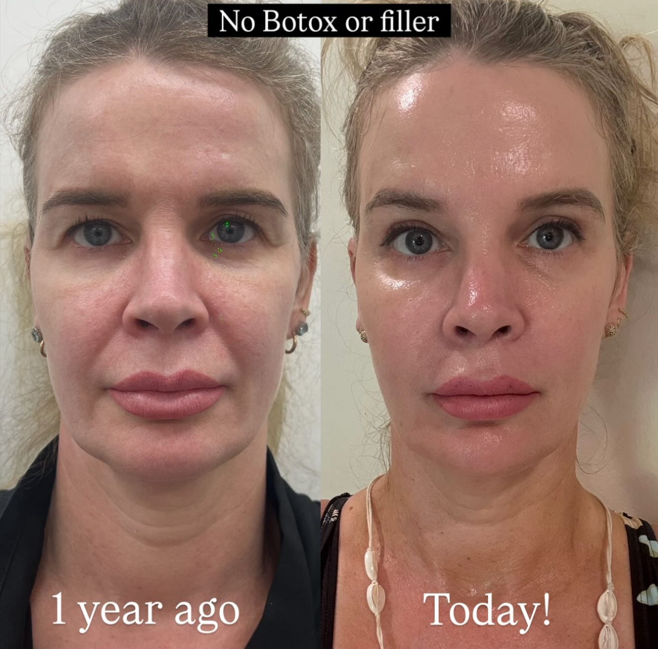 Ultraformer MPT before and after result