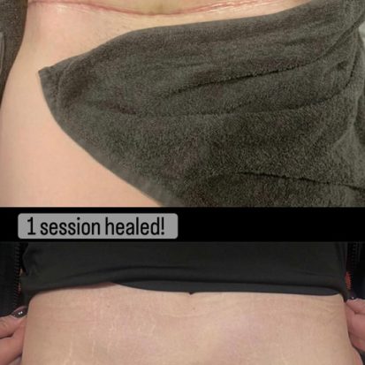 Parmedical tattooing Tummy tuck Melbourne
