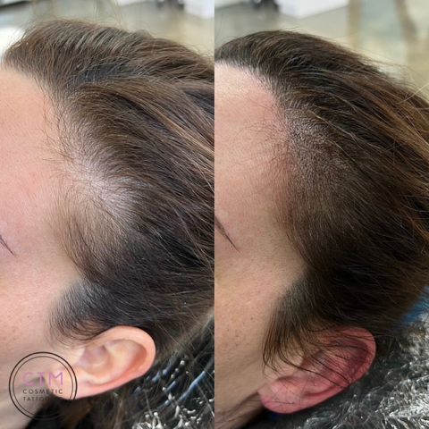 Scalp Micropigmentation