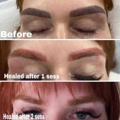 Picoway Tattoo Removal