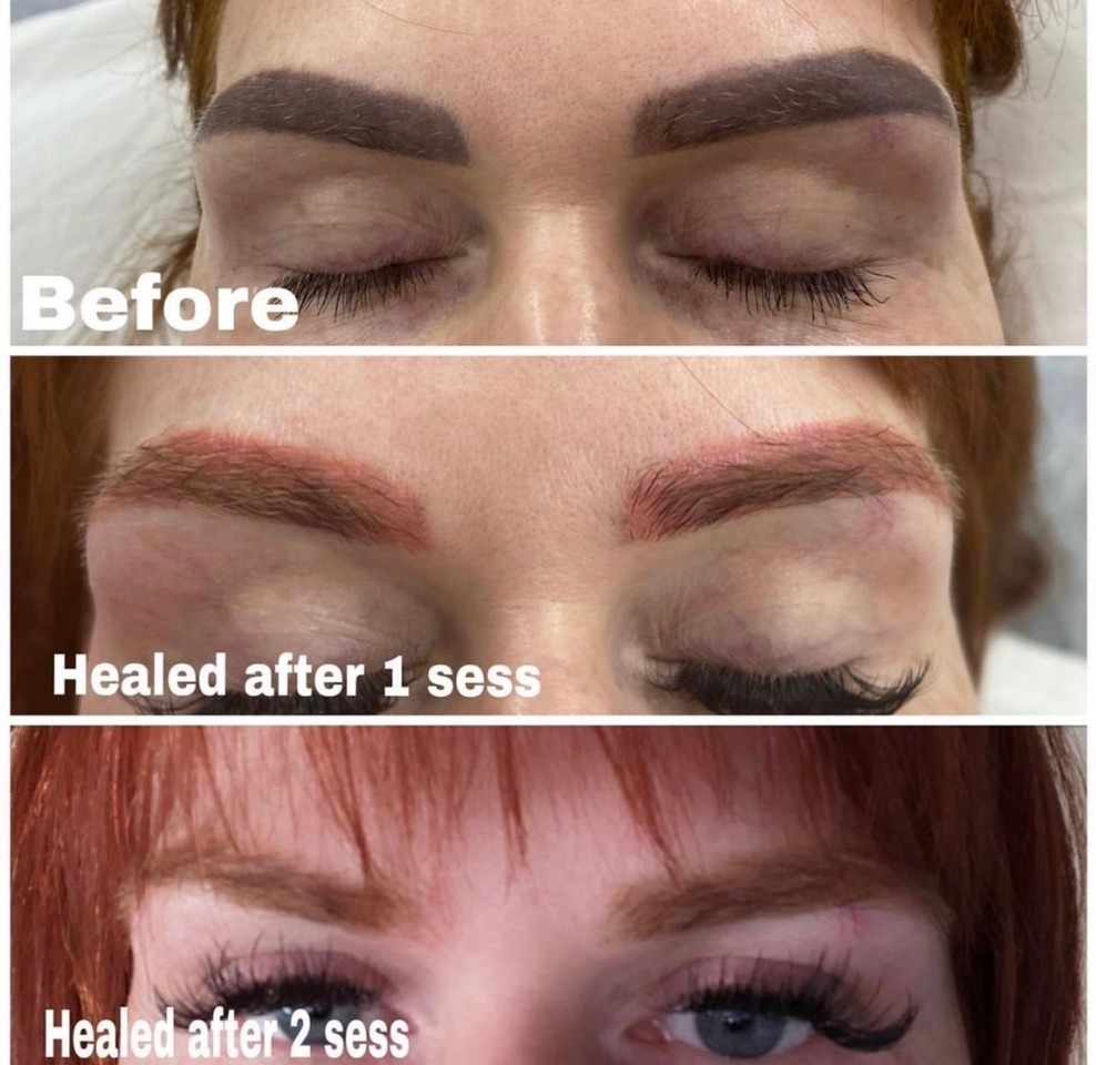 Picoway Tattoo Removal