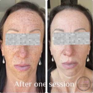 melasma-laser-treatment