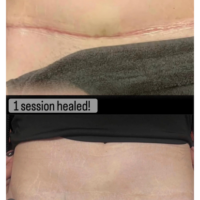 Parmedical tattooing Tummy tuck Melbourne Parmedical tattooing Tummy tuck Melbourne