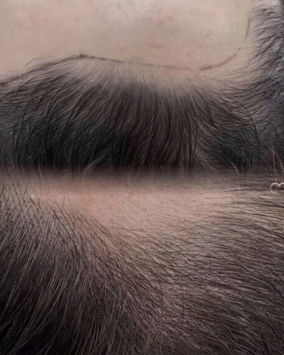 Scalp Hair Stroke Tattooing