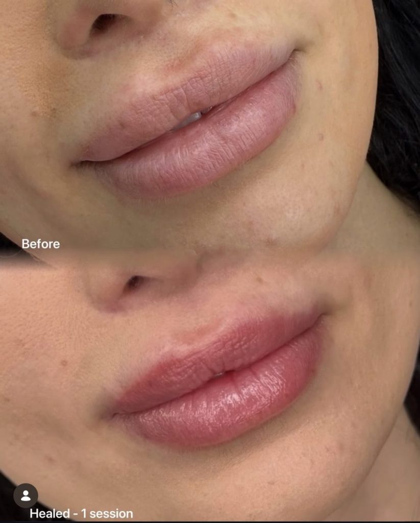 Lip blush tattoo before and after – Cosmetic Tattooing Melbourne, St Kilda