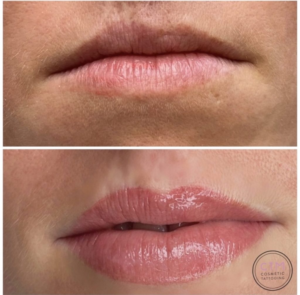 Reconstructive lip tattoo before and after – Cosmetic Tattooing Melbourne, St Kilda
