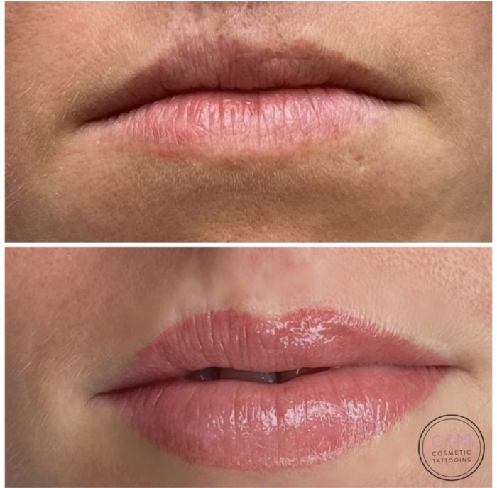 Reconstructive Lip at Cosmetic Tattooing Melbourne