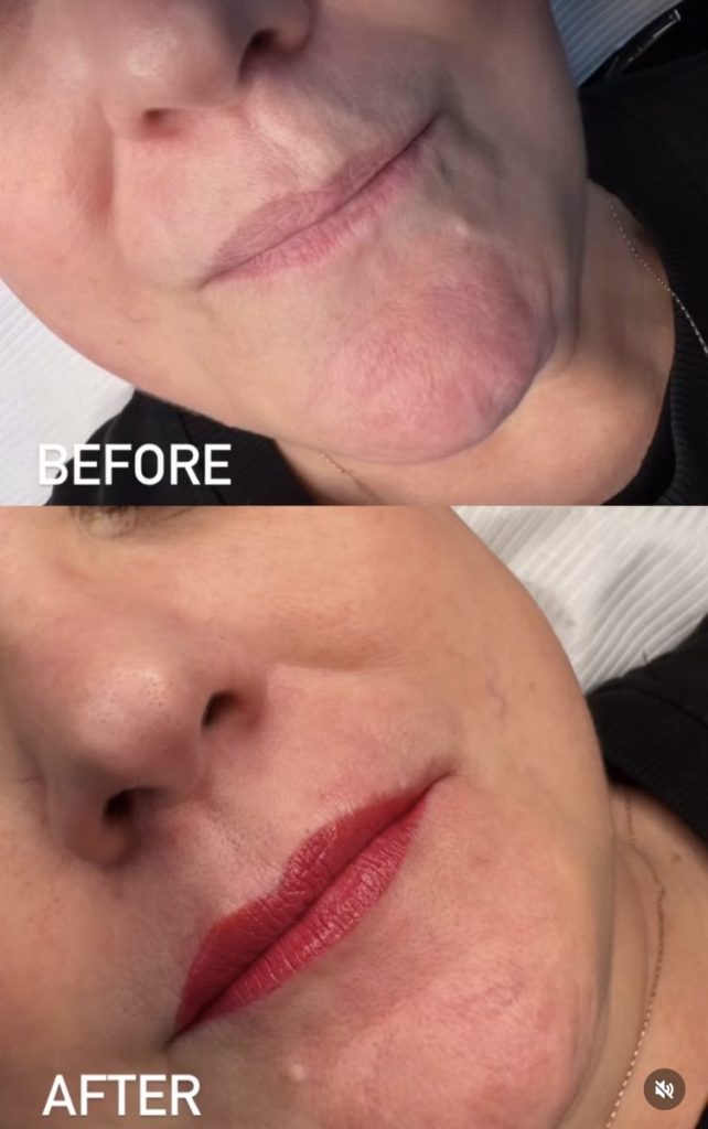 Reconstructive lip tattoo before and after – Cosmetic Tattooing Melbourne, St Kilda