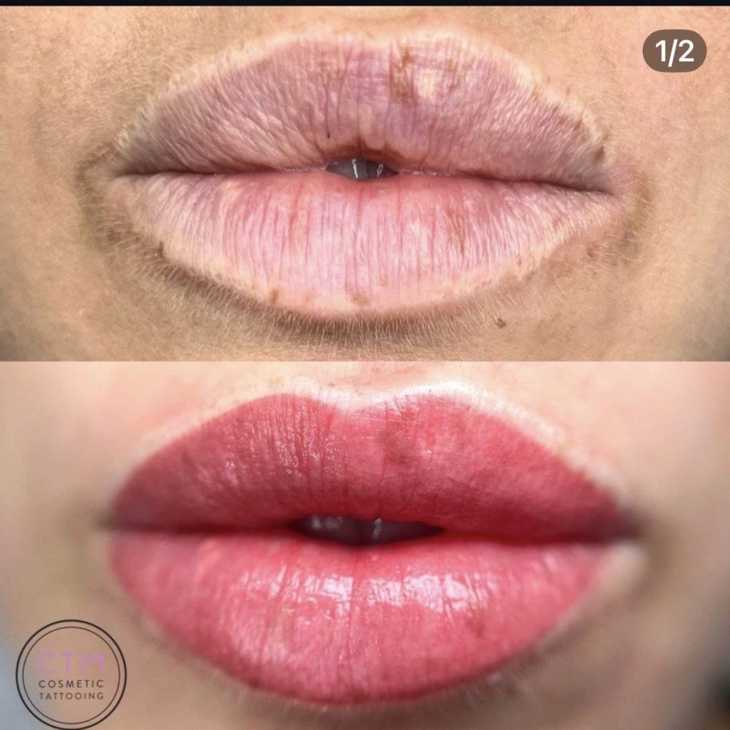 Reconstructive lip tattoo before and after – Cosmetic Tattooing Melbourne, St Kilda