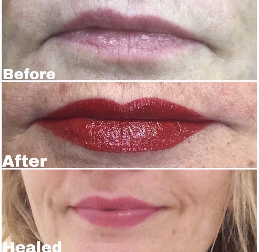 Reconstructive lip tattoo before and after – Cosmetic Tattooing Melbourne, St Kilda