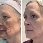 Plasma Fibroblast Treatment Melbourne