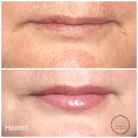 Lip Tattooing