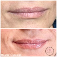 Melbourne Cosmetic Lip Tattoo