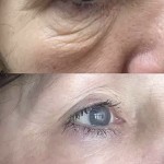 Plasma Fibroblast Melbourne