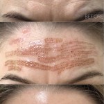 Plasma Fibroblast Therapy