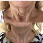 Plasma Fibroblast Treatment