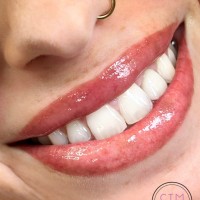 Cosmetic Teeth Whitening