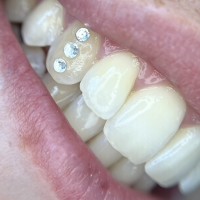 Melbourne tooth gems