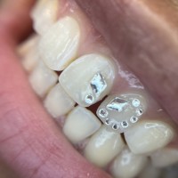 Melbourne Tooth Gem