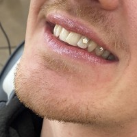 Melbourne tooth gems