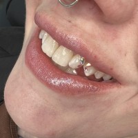 tooth gems melbpurne