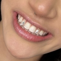 Tooth gems