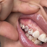 melbourne tooth gems