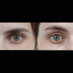 HIFU Treatment near me