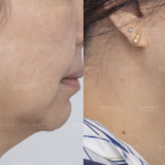 High Intensity Focused Ultrasound - Before And After